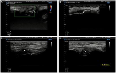 Upadacitinib sustained-release tablets for the treatment of chronic refractory gouty arthritis: a case report and literature review